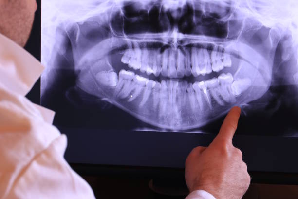 Best Emergency Treatment for Dental Infections or Abscesses in Sag Harbor, NY